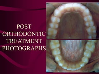 POST
ORTHODONTIC
TREATMENT
PHOTOGRAPHS
 