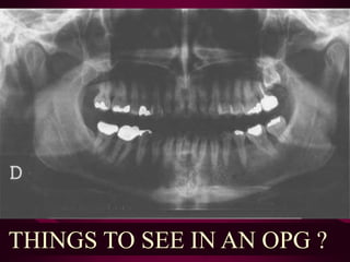 THINGS TO SEE IN AN OPG ?
 