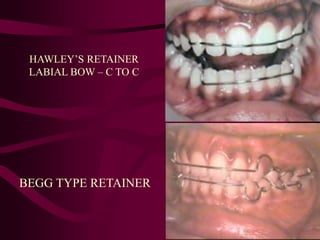 HAWLEY’S RETAINER
LABIAL BOW – C TO C
BEGG TYPE RETAINER
 