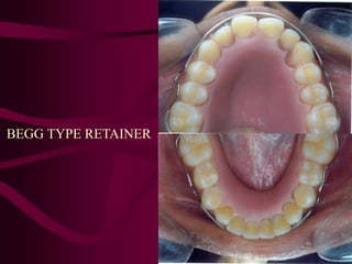 BEGG TYPE RETAINER
 