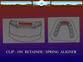 RETENTION AND RELAPSE O.ppt