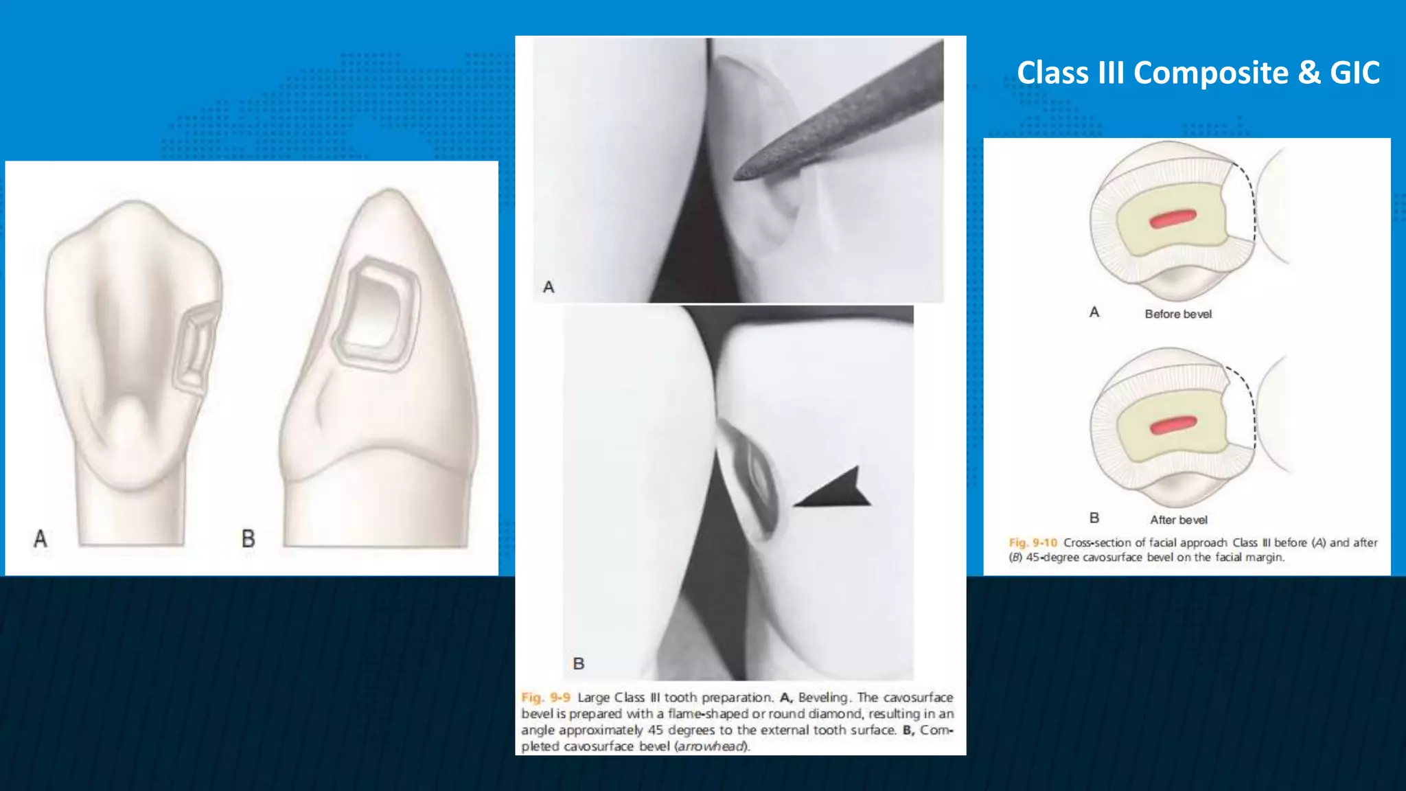 Retention and resistance forms of cavity design | PPTX