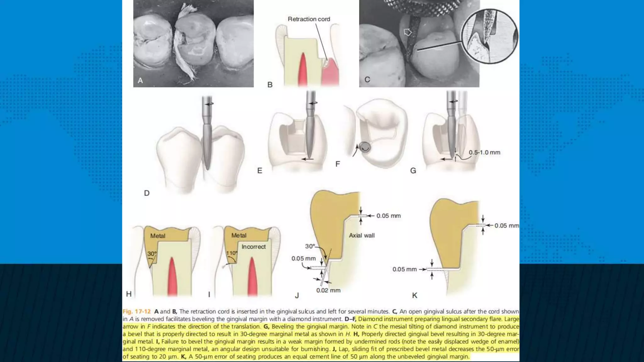 Retention and resistance forms of cavity design | PPTX
