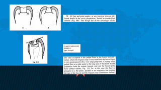 Retention and resistance forms of cavity design | PPTX