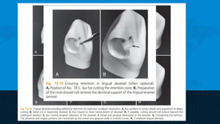 Retention and resistance forms of cavity design | PPTX