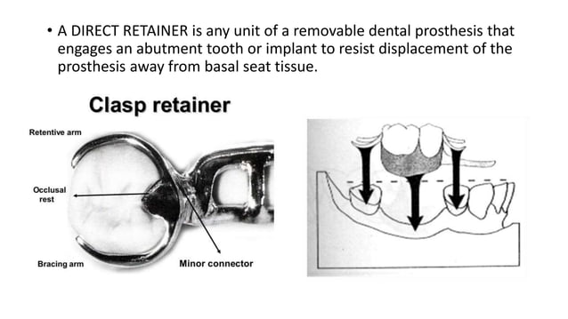 Retainer In Rpd Retention and support in removable partial denture kalpana | PPTX ...
