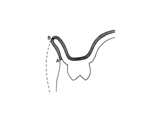 TION
gas always exists due to the
s dissolved in the saliva. The
ses or air inclusions serves to
s of atmospheric pressure pro-
of the authors are also in
arch results cited. The intro-
perforation or the presenceof
palatal seal markedly reduces
of most maxillary complete
would not be observed if the
hesion, which depend primar-
of intimate contact, were the
Certainly removal of a poste-
ement of a 1 mm perforation
er the surface area.
CAL FACTORS
udies and observations clearly
ention of complete dentures.
eated at the meniscus of the
a pressure gradient between
e and the reduced pressure
hat occurs during dislodging
Fig. 5. Thin fluid film exists (shaded area) between
denture base and tissues of residual ridges. Meniscus
that develops at border of denture is similar to that
shown in Fig. 4 between two glass slabs. Note that
position of meniscus will depend on where soft tissue
loses contact with denture border. Draping effect of
cheeks may provide a meniscus along polished surface
of denture border CA). When cheek is retracted, menis-
 