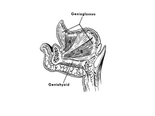 Genioglossus
Fig. li. Genioglossus muscle in cross section, illus-
trating two main divisions. Superior fibers, A, are
contracted, depressing central body of tongue .and
causing tip to be retracted and floor of mouth to reach
its most superior position. B, Inferior fibers of genio-
glossus.
Superior most floor
of mouth
Fig. 13. A technique for establish
seal is diagrammed. First, dentu
molded to contact superiormost
mouth. Extension posteriorly t
folds should maintain a border
mouth is at rest.
 