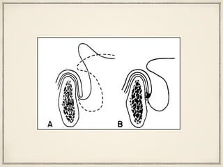 section, illus-
ibers, A, are
tongue .and
outh to reach
ers of genio-
UAL
btain a border
he mylohyoid
y to raise the
seal is diagrammed. First, denture must be border-
molded to contact superiormost level of floor of
mouth. Extension posteriorly to contact sublingual
folds should maintain a border seal when floor of
mouth is at rest.
Fig. 14. A second technique. to establish anterior lin-
gual seal. A, Denture is extended to most superior
level of floor of mouth. B, Slight pressure on mucosa
overlying lingual slope of anterior mandible ensures a
border seal when tongue is at rest.
 