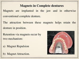 Magnets are implanted in the jaw and in otherwise
conventional complete denture.
The attraction between these magnets helps retain the
denture in position.
Magnets in Complete dentures
Retention via magnets occur by
two mechanism:
a)  Magnet Repulsion
b)  Magnet Attraction.
 