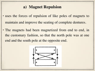 • uses the forces of repulsion of like poles of magnets to
maintain and improve the seating of complete dentures.
• The magnets had been magnetized from end to end, in
the customary fashion, so that the north pole was at one
end and the south pole at the opposite end.
little loss of energy.
Changes in Magnet Design.-To accompany the change in direction
netization a change in design was made. By flattening the magnets, m
lines of force between the two magnets were shortened and greater e
made available. As shown in Fig. 11, A, with a cross section of cylindric
the central line of force is the shortest; those at the periphery are longer
sequently, weaker. With a cross section of flattened magnets (Fig. 11,
of the lines of force are short and, consequently, stronger. The shape of
now is that of a flattened cylinder, l/4 inch in length, less than rA inch
and a little more than G inch in width. To be precise, it measures 0.25
0.10 inch (6.35 by 3.55 by 2.54 mm.) (Fig. 12, B).
Changes in the Mesh Overlay.-The second time the new flattened
magnetized through the diameter, were used, an interesting phenom
curred (Table I, case 3). The magnet was so strong that it was a
the needle used to suture the mucoperiosteum. It followed the directio
1”“’
t+q
I I
1 1
t t
a)  Magnet Repulsion
 