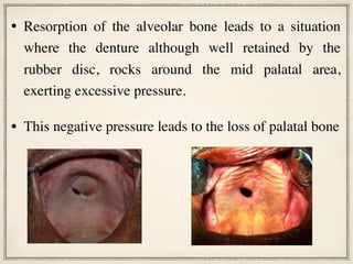 • Resorption of the alveolar bone leads to a situation
where the denture although well retained by the
rubber disc, rocks around the mid palatal area,
exerting excessive pressure.
• This negative pressure leads to the loss of palatal bone
 