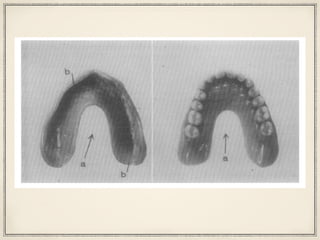 680 KUBALI 5. Pros. Den.
Julz+August, 1960
Fig. 10. Fig. 11.
Fig. lO.-The tissue surface of a denture constructed by the functional vacuum method: (a)
the palatal base material is not present; (b) the packing ring belt is placed around the borders.
Fig. Il.-The palatal portion of the denture is not needed in the functional vacuum method.
 