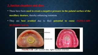 3. Suction chambers and discs
• These have been used to create a negative pressure in the palatal surface of the
maxillary denture, thereby enhancing retention.
• They are best avoided due to their potential to cause PAPILLARY
HYPERPLASIAS.
 