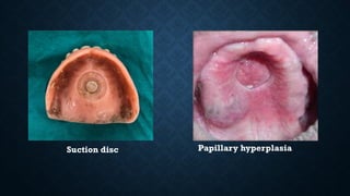 Suction disc Papillary hyperplasia
 