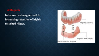 4.Magnets
Intramucosal magnets aid in
increasing retention of highly
resorbed ridges.
 