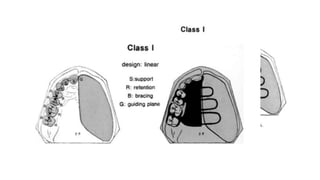 Retention in maxillofacial prosthesis pptx | PPTX