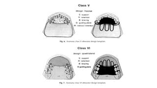Retention in maxillofacial prosthesis pptx | PPTX