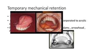 Retention in maxillofacial prosthesis pptx | PPTX