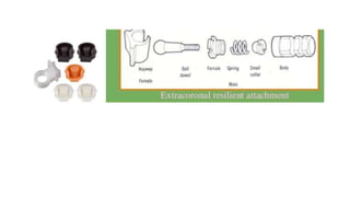 Retention in maxillofacial prosthesis pptx | PPTX