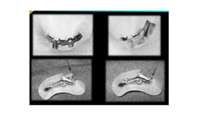 Retention in maxillofacial prosthesis pptx | PPTX