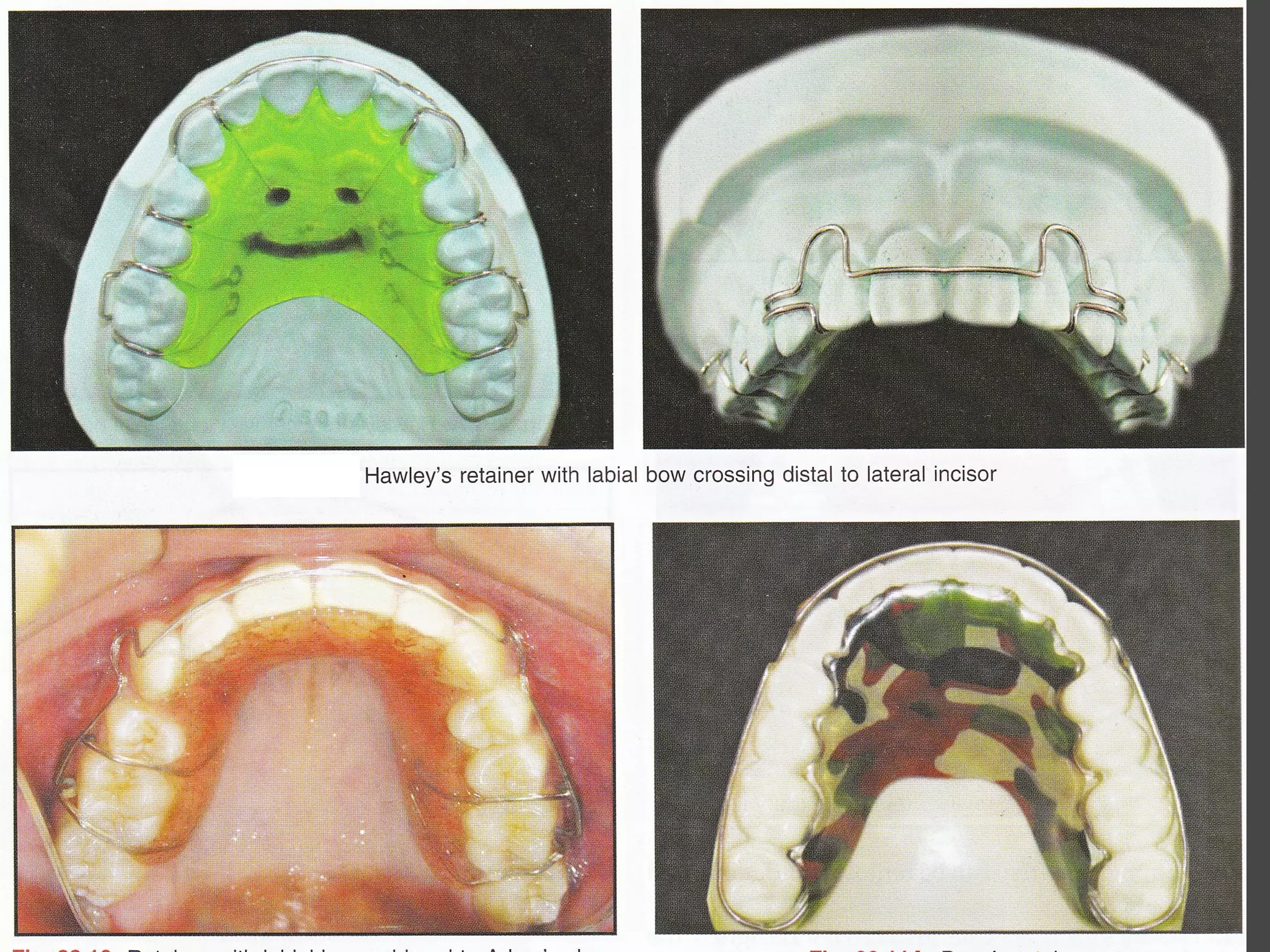 Retention in orthodontics | PPT