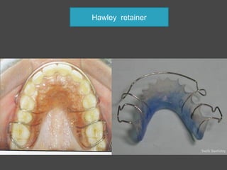 Hawley Retainer Instructions.pdf Retention in orthodontics | PPT