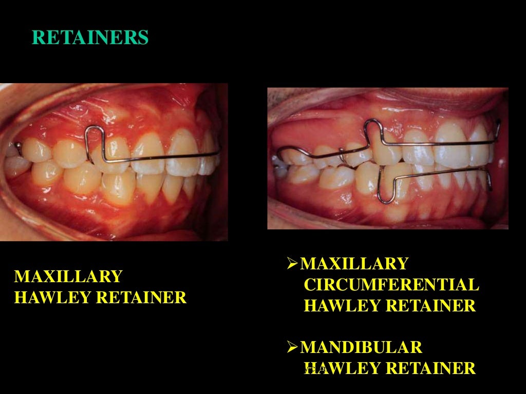 Retention /certified fixed orthodontic courses by Indian dental acad…