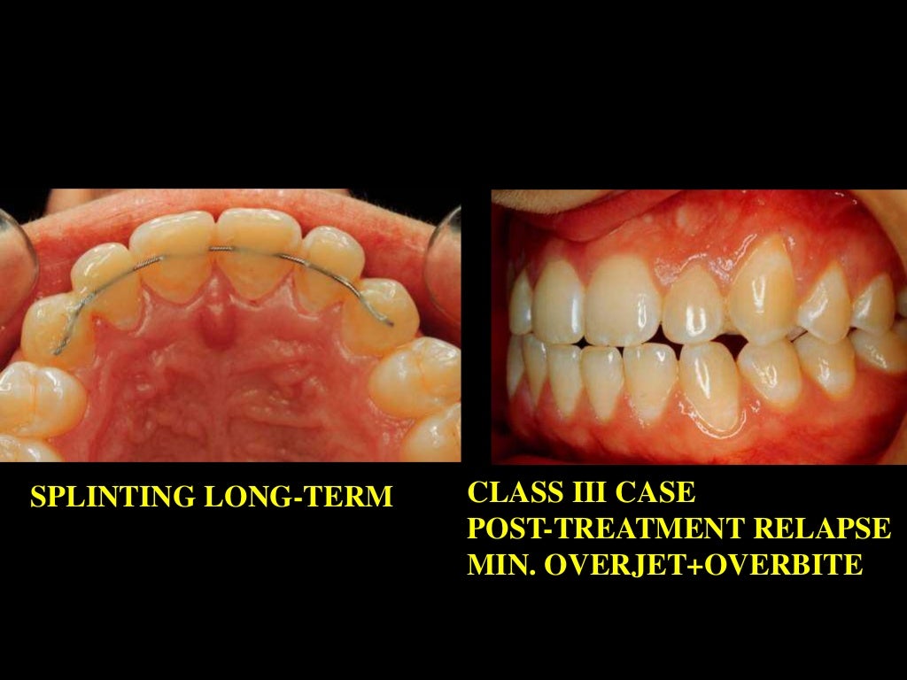 Retention /certified fixed orthodontic courses by Indian dental acad…