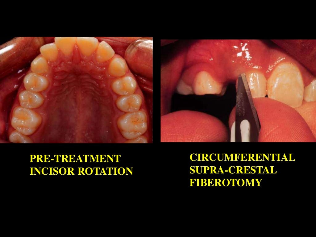 Retention /certified fixed orthodontic courses by Indian dental acad…