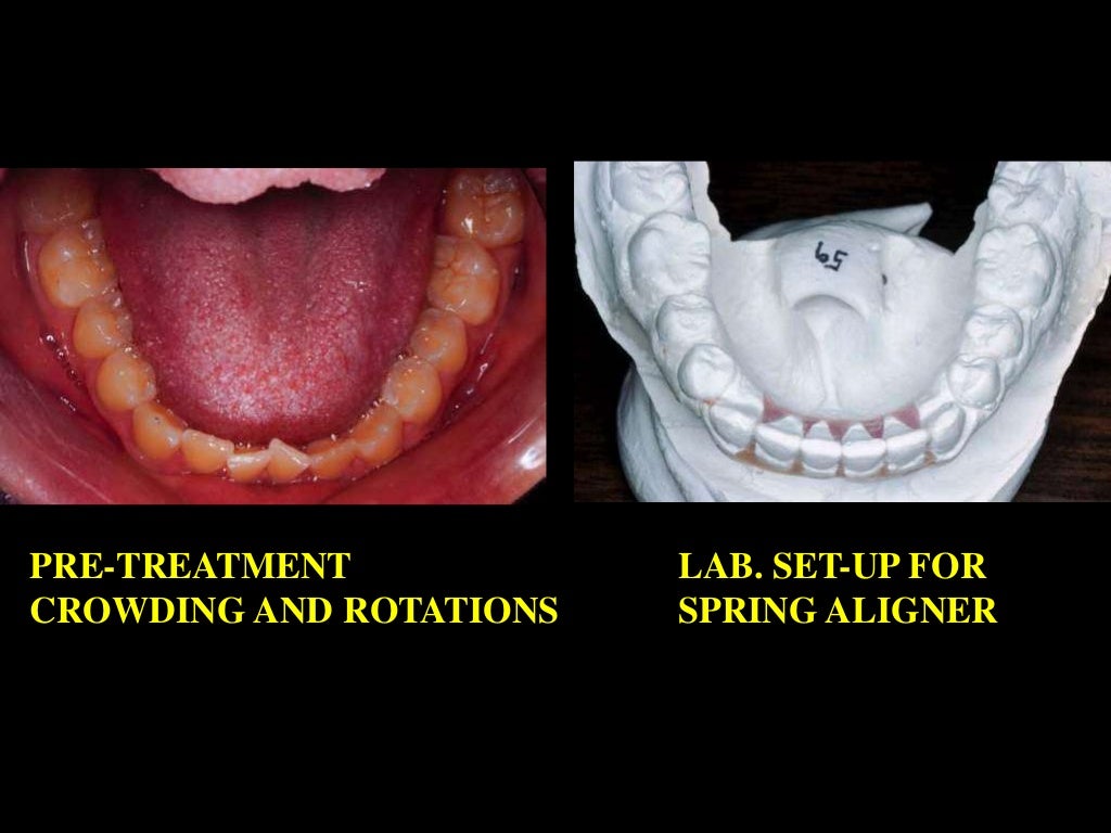 Retention /certified fixed orthodontic courses by Indian dental acad…
