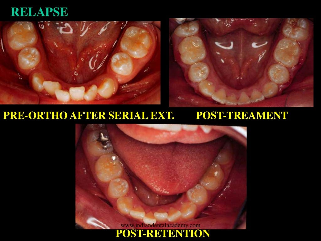Retention /certified fixed orthodontic courses by Indian dental acad…