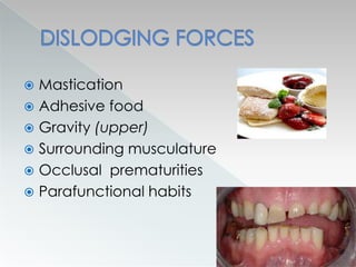  Mastication
 Adhesive food
 Gravity (upper)
 Surrounding musculature
 Occlusal prematurities
 Parafunctional habits
 