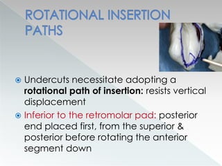  Undercuts necessitate adopting a
rotational path of insertion: resists vertical
displacement
 Inferior to the retromolar pad: posterior
end placed first, from the superior &
posterior before rotating the anterior
segment down
 