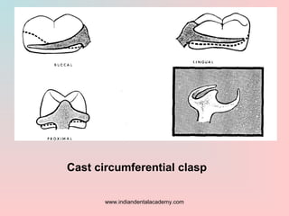 Cast circumferential clasp
www.indiandentalacademy.com
 