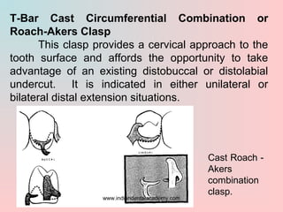 T-Bar Cast Circumferential Combination or
Roach-Akers Clasp
This clasp provides a cervical approach to the
tooth surface a...