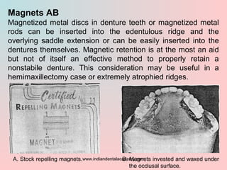Magnets AB
Magnetized metal discs in denture teeth or magnetized metal
rods can be inserted into the edentulous ridge and ...