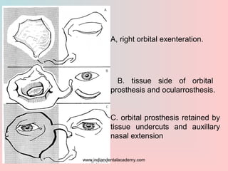 A, right orbital exenteration.
B. tissue side of orbital
prosthesis and ocularrosthesis.
C. orbital prosthesis retained by...