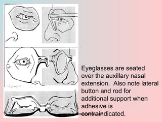 Eyeglasses are seated
over the auxillary nasal
extension. Also note lateral
button and rod for
additional support when
adh...