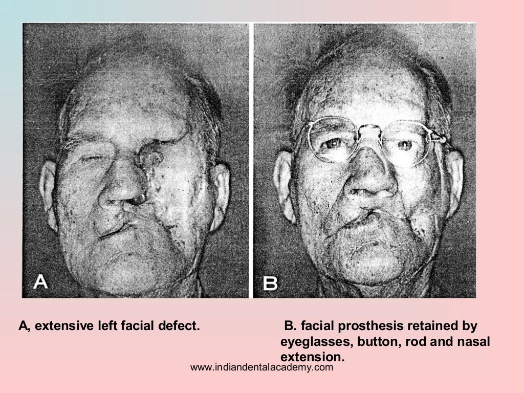 Retention of maxillofacial prosthesis/ oral surgery courses