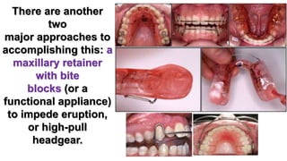 Retention of open bite | PPTX