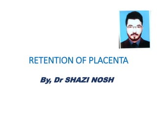 RETENTION OF PLACENTA
By, Dr SHAZI NOSH
 