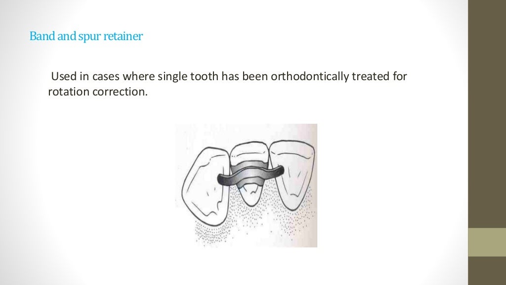 Retention & relapse in orthodontics