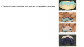 Retention, Stability, and Support in Complete Denture Prosthodontics ...