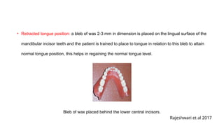 Normal Bleb Retention, Stability, and Support in Complete Denture Prosthodontics ...