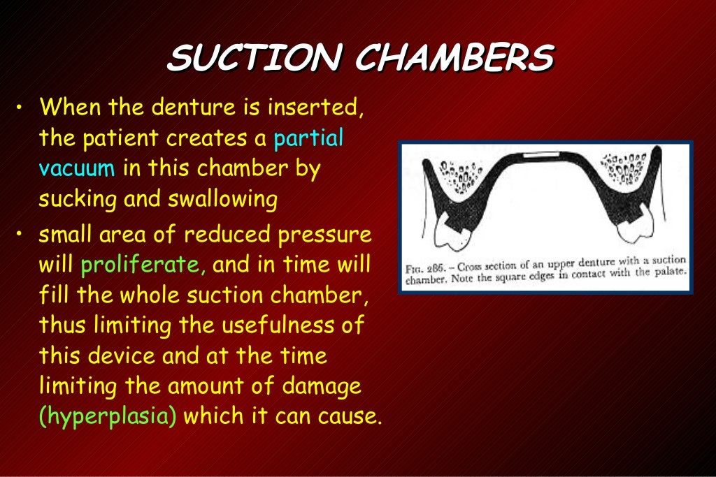 Retention,stability& support in dentures / dental implant courses by