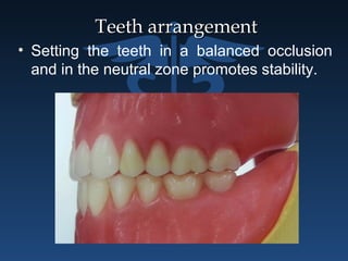 Teeth arrangementTeeth arrangement
• Setting the teeth in a balanced occlusion
and in the neutral zone promotes stability.
 