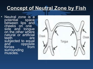 Concept of Neutral Zone by Fish
• Neutral zone is a
potential space
between lips and
cheeks on one
side and tongue
on the other where
natural or artificial
teeth are
subjected to equal
and opposite
forces from
surrounding
muscles.
 