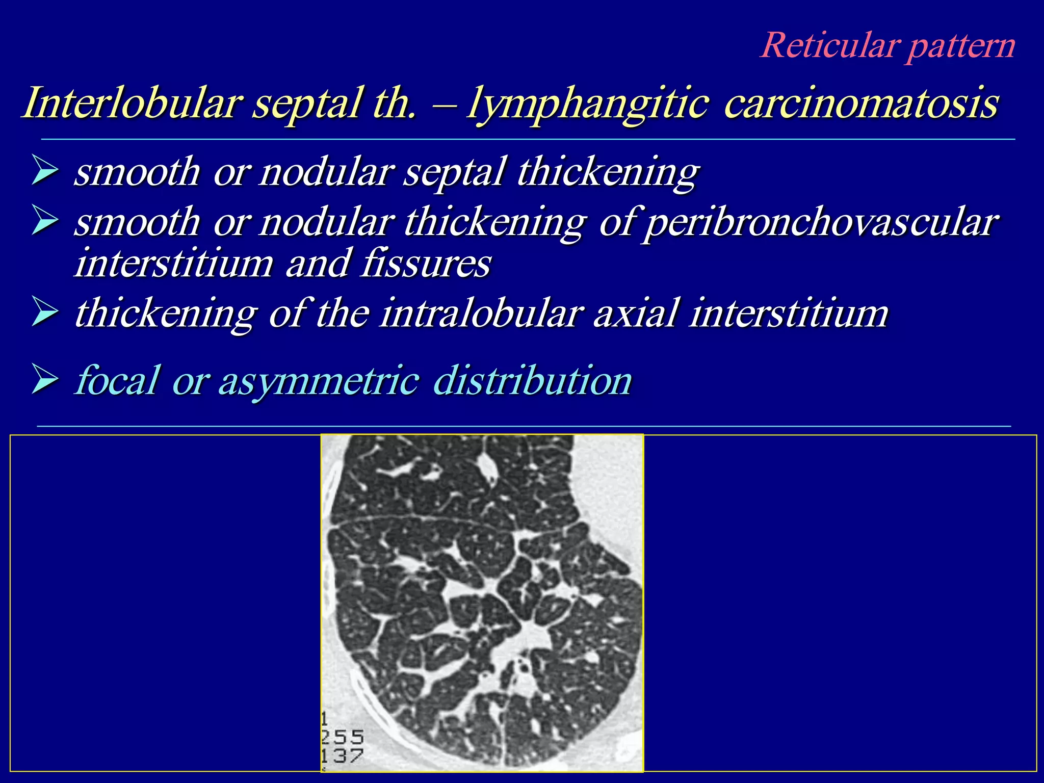 Reticular pattern
Interlobular septal th. – lymphangitic carcinomatosis
 smooth or nodular septal thickening
 smooth or nodular thickening of peribronchovascular
interstitium and fissures
 thickening of the intralobular axial interstitium
 focal or asymmetric distribution
 