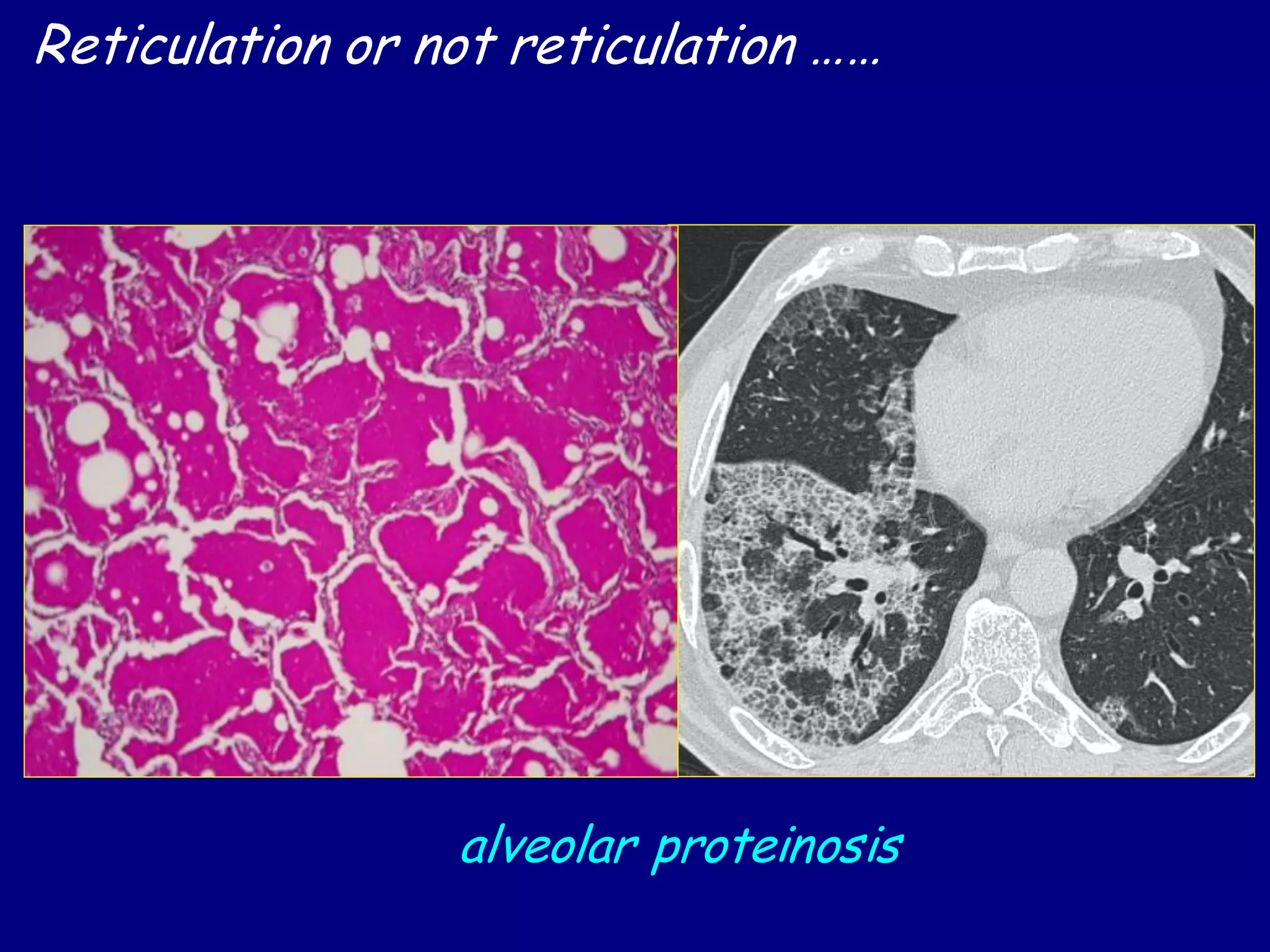 Reticulation or not reticulation ……
alveolar proteinosis
 